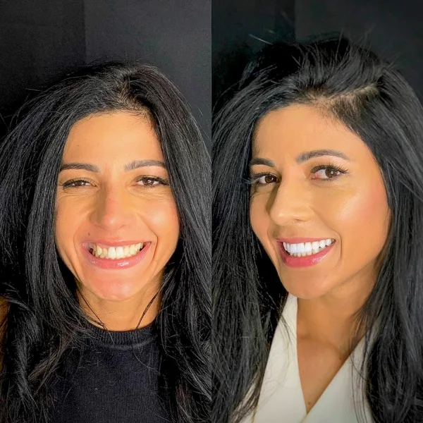 Paciente da Dentista Méier antes e depois das lentes de contato dental